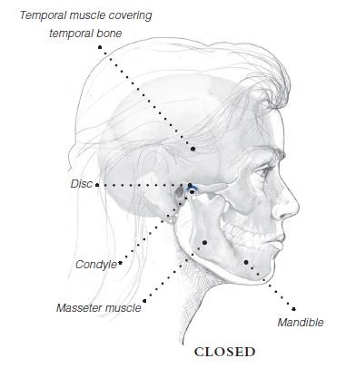 TMJ diagram (closed), idicating temporal muscle covering temporal bone, disc, condyle, masseter muscle, and mandible.