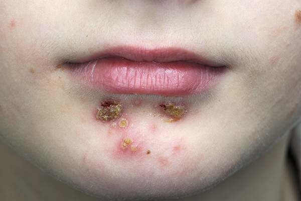 Impetigo on child