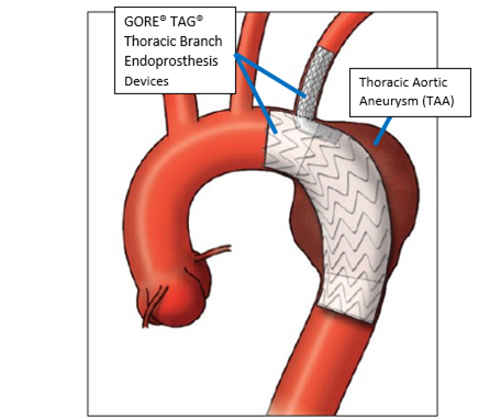 Image of GORE TAG Thoracic Branch Endoprosthesis