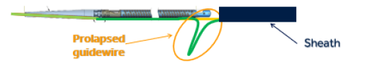 Photo of Prolapsed Guidewire