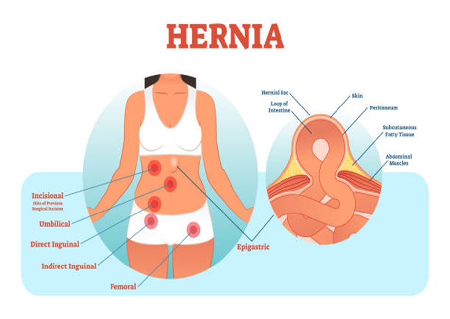 Diagram of common types of hernias; incision – site of protrusion, surgical incision Umbilical – occurs in belly button Inguinal- occurs in the inner groin Femoral- occurs in the upper thigh/outer groin Epigastric – occurs between the breastbone and the belly button. 