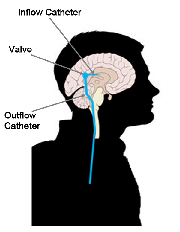 Side-view of implanted CSF shunt system.