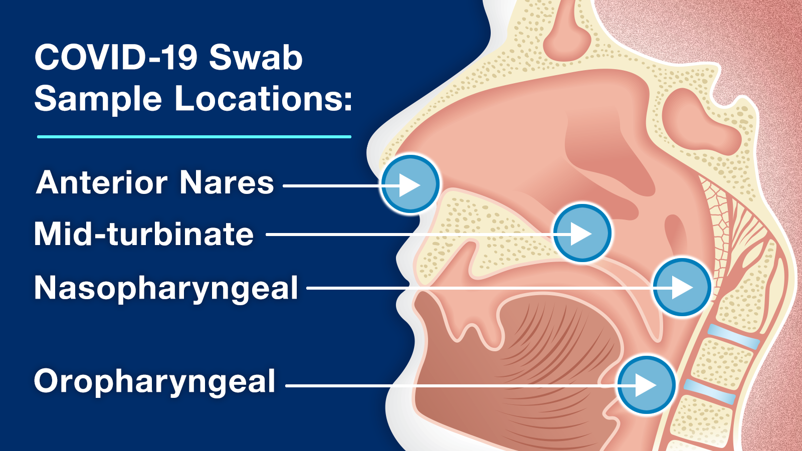 COVID-19 swab sample locations: Anterior Nares, Mid-turbinate, Nasopharyngeal, and Oropharyngeal