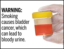 A rectangular cigarette health warning with a white background and black text that reads: “WARNING: Smoking causes bladder cancer, which can lead to bloody urine.” To the right of the text is a photorealistic illustration showing a gloved hand holding a urine specimen cup containing bloody urine resulting from bladder cancer caused by cigarette smoking. The warning is surrounded by a black outline.