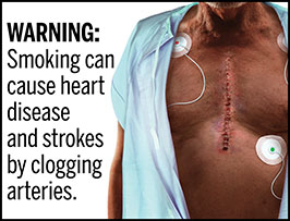 A rectangular cigarette health warning with a white background and black text reads: "WARNING: Smoking can cause heart disease and strokes by clogging arteries."  Next to the text is a photorealistic illustration of a chest of a man (aged 60-70 years) wearing an open hospital gown who recently underwent surgery to treat heart disease caused by smoking. . A large, recently-sutured incision running down the middle of his chest and is undergoing post-operative monitoring. The warning has a black border.