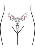 picture of surgical sterilization implant