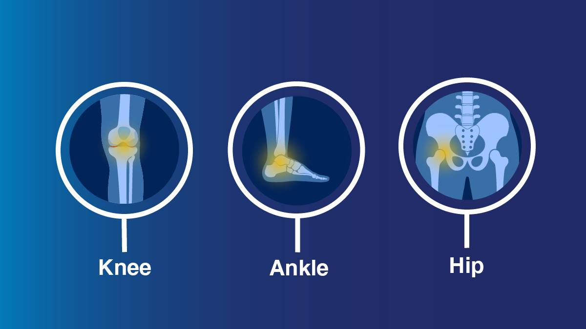 Graphic with three circles with photos drawings of a knee, ankle and hip.  Each one contains a highlighted area showing where a replacement would go. 