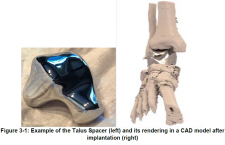 Picture of Patient Specific Talus spacer (left) and picture of device after implantation (right)