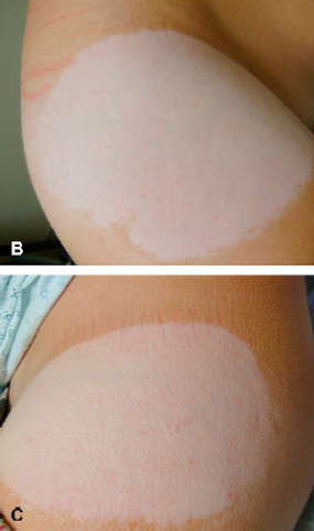 Figure 1.B and 1.C Chemical Leukoderma