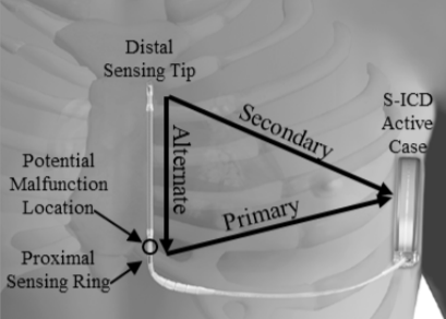 Picture of the EMBLEM S-ICD Subcutaneous Electrode with an arrow showing where separation usually happens (distal to the proximal sense ring).