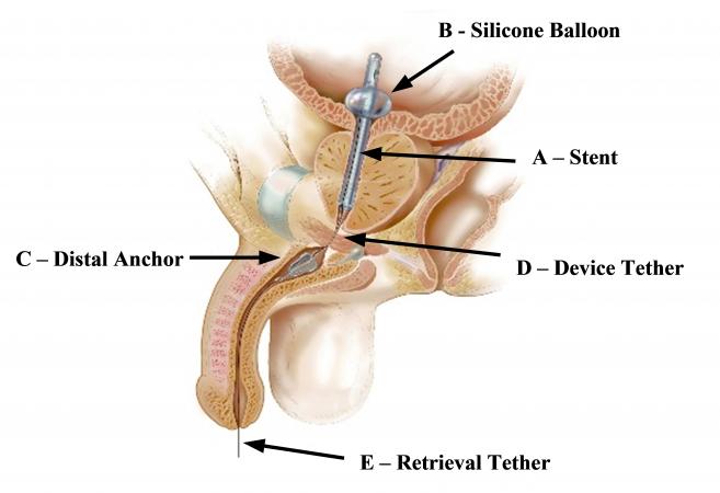 A cross section showing the Spanner placed properly in the urethra with labels for the balloon, stent, tether, anchor, and retrieval string.