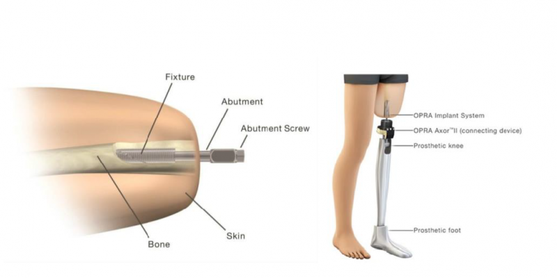 Osseonachored Prostheses for Rehabiliation of Amputees (OPRA)TM Implant System – P190009