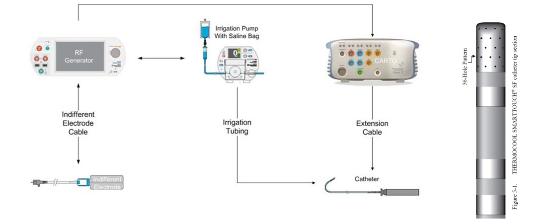 THERMOCOOL SMARTTOUCH SF Bi-Directional Navigation Catheter 