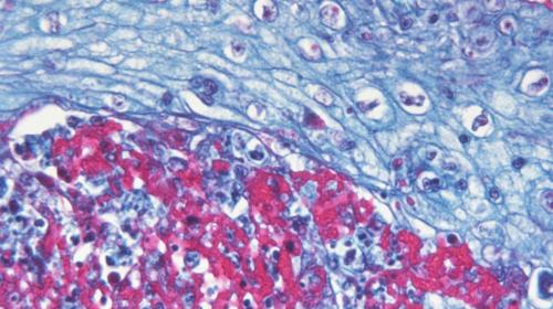 Photomicrograph demonstrating some of the histopathologic changes in a human skin tissue sample infected with the variola (smallpox) virus. (Credit: CDC)