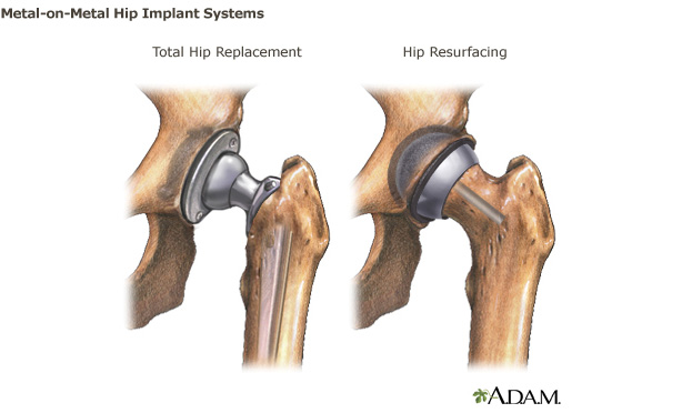 Drawing of the types of metal-on-metal hip implant systems that are currently available: metal-on-metal total hip replacment system and metal-on-metal hip resurfacing system.