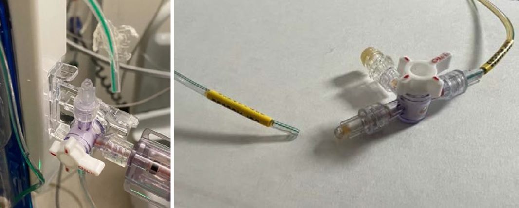 Duet EMDS catheters disconnected from Luer connectors