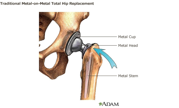 Hip Replacement