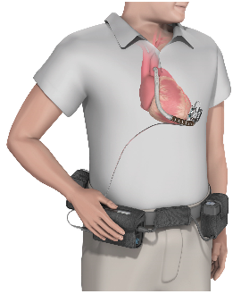 Illustration of the HVAD Pump Implant Kit on a patient.