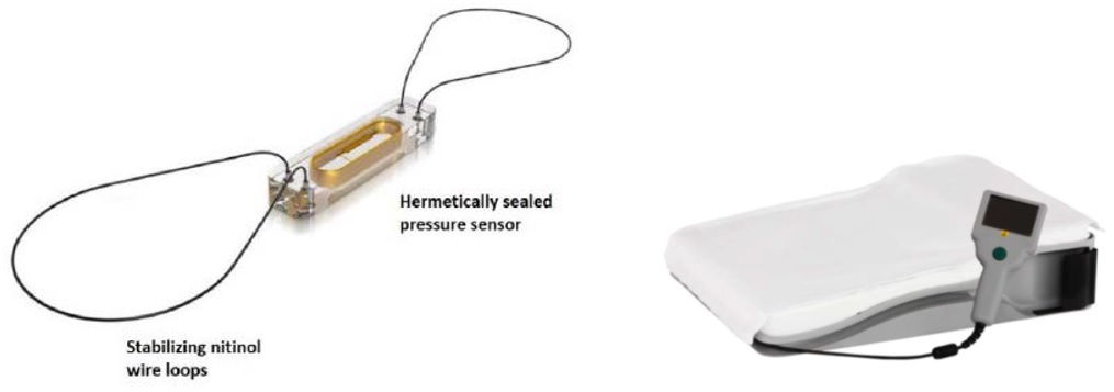 Image of the CardioMEMS HF System, indicating stabilized nitinol wire loops and hermetically sealed pressure sensor.