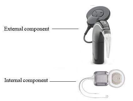 Image of the external component and internal component of the Nucleus 24 Cochlear Implant System