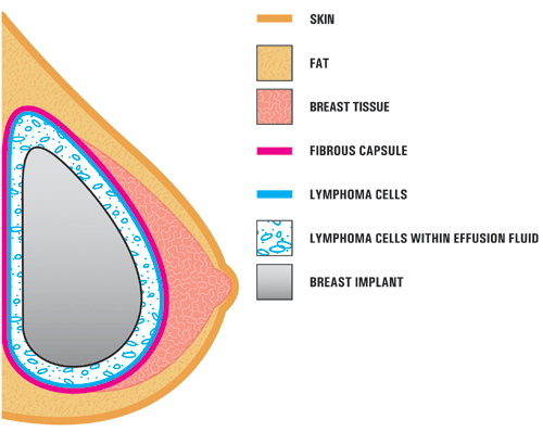 This illustration shows the breast implant placed under the skin and breast tissue. The implant is separated from the breast tissue by a fibrous scar capsule. ALCL lymphoma cells are shown in the effusion fluid between the breast implant and the capsule and attached to the capsule itself.