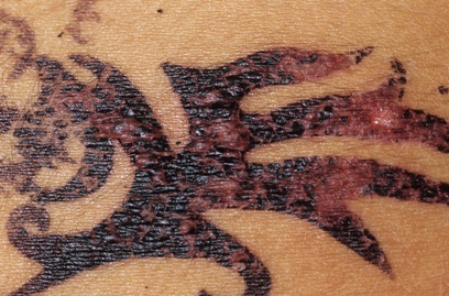 Allergic Reaction to a henna tattoo, showing red bumps on the tattoo