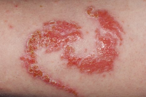 Allergic reaction to a henna tattoo, showing red bumps in the pattern of the tattoo