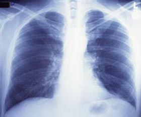 Image of a Chest  X-Ray