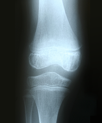 Juvenile Arthritis Knee X-Ray (350x422)