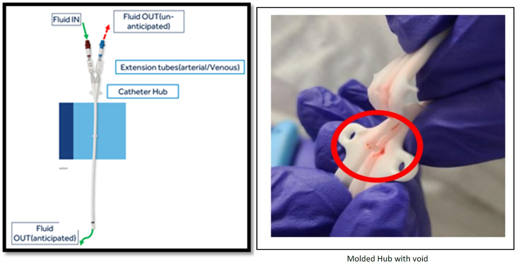 Palindrome and Mahurkar Hemodialysis Catheters