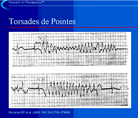 Torsades de Pointes