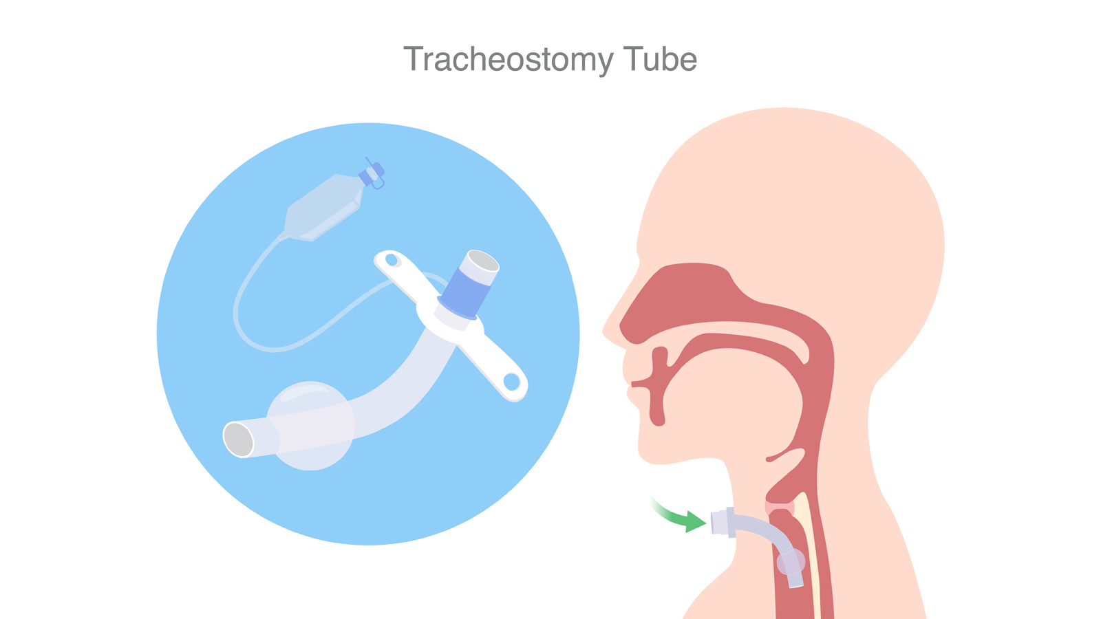 Diagram of a tracheostomy tube in a patient.