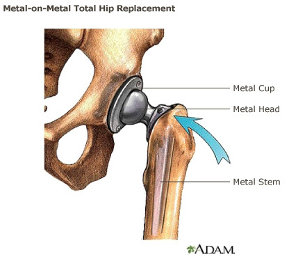 Drawing of a metal-on-metal total hip replacement system. The diseased parts of the hip are removed and replaced with a system comprised of a metal ball, metal stem and a metal