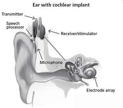 Ear with cochlear implant  - Source: NIH/NIDCD