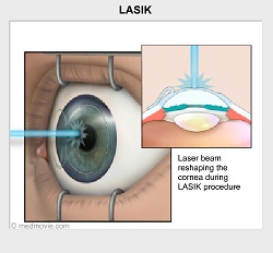 Lasik animation. Alternative text available behind this link.