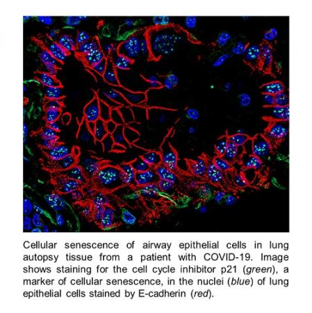 Cellular senescence of airway epithelial cells in lung autopsy tissue from a patient wirh COVID-19. Image shows staining for the cell cycle inhibitor p21 (green), a marker of cellular senescence, in the nuclei (blue) of lung epithelial cells stained by E-cadherin (red).