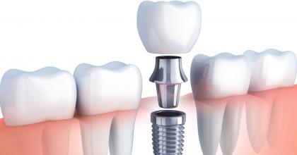 Structure of the Dental Implant system: This diagram shows the crown, abutment, and implant body as separate pieces and as an implant in the gum, next to a tooth. 