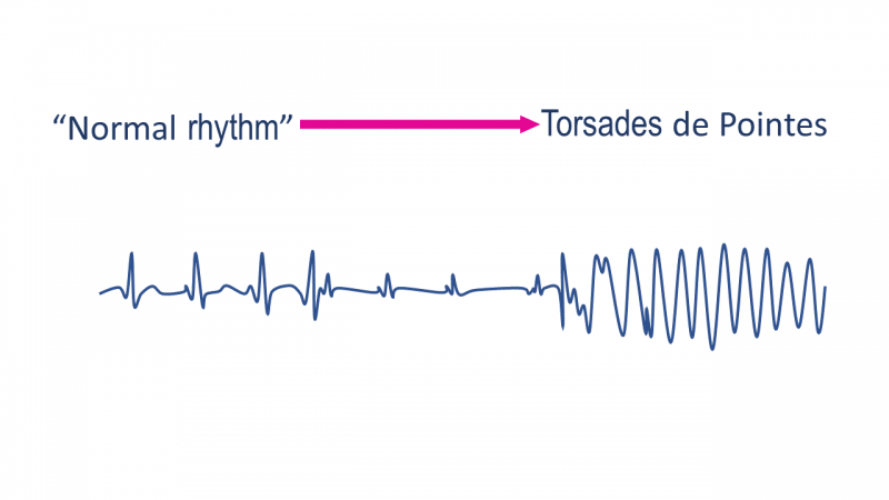 Electrocardiogram 