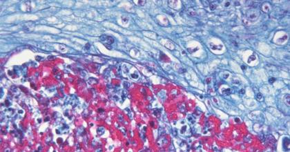 Photomicrograph demonstrating some of the histopathologic changes in a human skin tissue sample infected with the variola (smallpox) virus. (Credit: CDC)