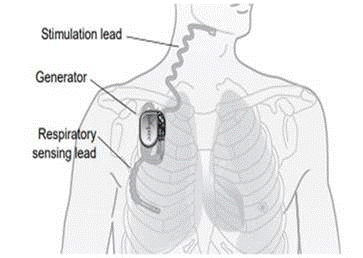 Drawing of where Inspire® Upper Airway Stimulation is implanted in the chest.