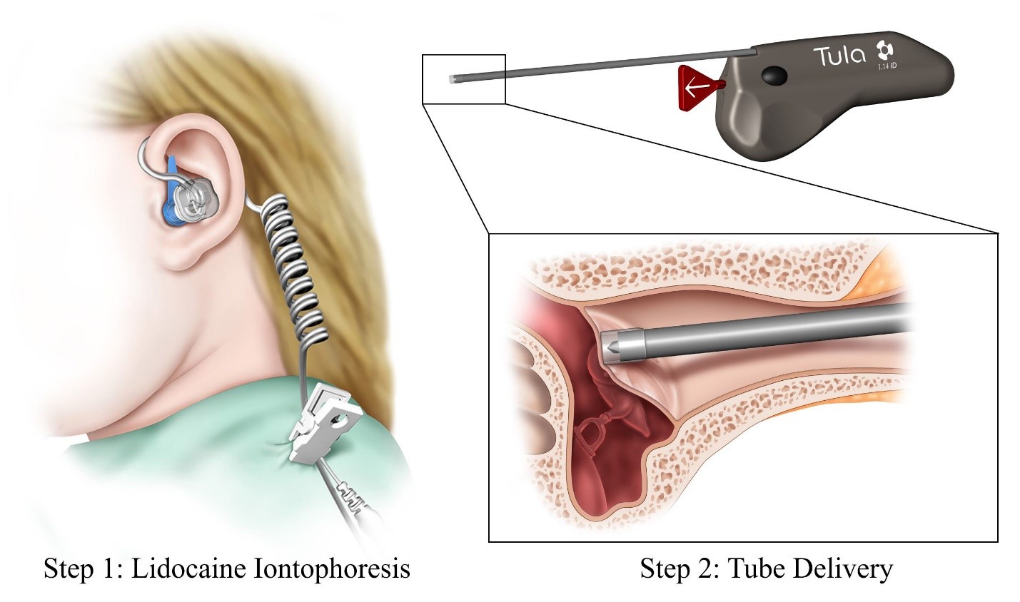Tula® System showing Step 1: Lidocaine Iontophoresis and Step 2: Tube Delivery