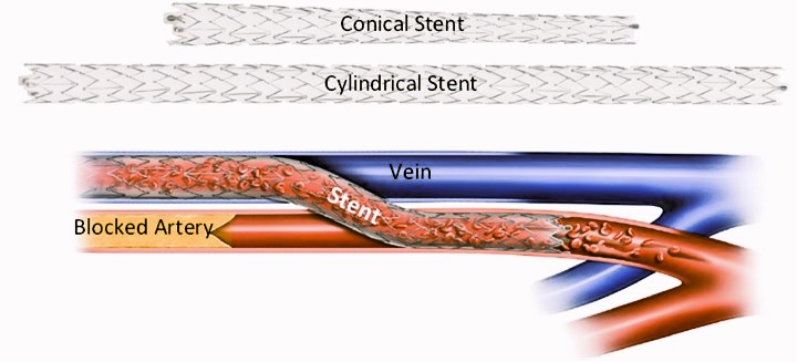 Conical Stent Cylindrical Stent Vein (blue) Stent crossing from artery to vein Artery (red) Buildup of a blocked artery. 