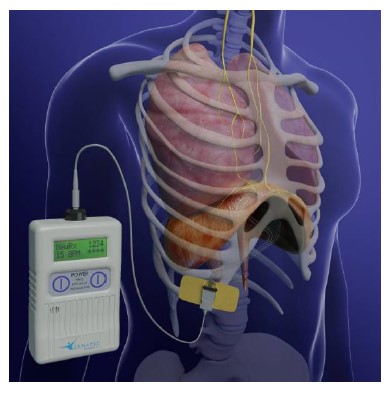 The main parts of the NeuRx Diaphragm Pacing System, including where electrodes are placed on the body.  