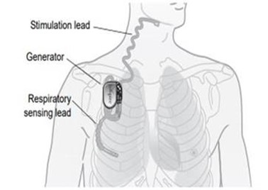 Location of where each of the Inspire Upper Airway Stimulation device components are placed in the body. 
