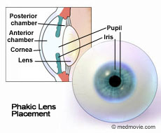 Phakic Lens Placement
