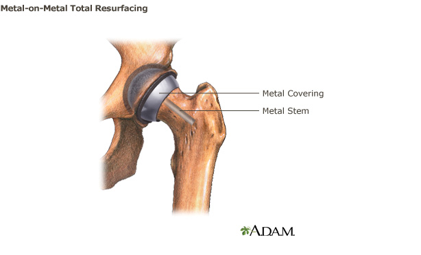 Drawing of a metal-on-metal total resurfacing system. A metal cap is placed over the ball portion of the femoral head.