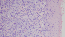 Microscopic view of cat oral squamous cell carcinoma tumor. Photo courtesy of Dr. Shelley Newman, University of Tennessee, Knoxville.