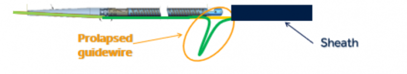 Figure 1 - Prolapsed guidewire illustrated example