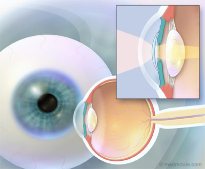 Drawing of eye with phakic lens