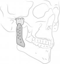 Picture of a TMJ implant.